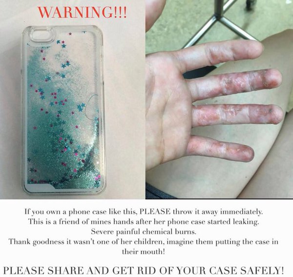 これは怖い。液体入りiPhoneケースで火傷被害が多発！